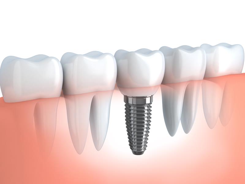 Dental Implants Hapeville, GA 